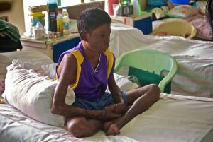 Filipinas tiene la mayor incidencia de lepra en la región. Se identificaron unos 1.700 en cada uno de los últimos tres años. Crédito: moyerphotos/CC by 2.0.